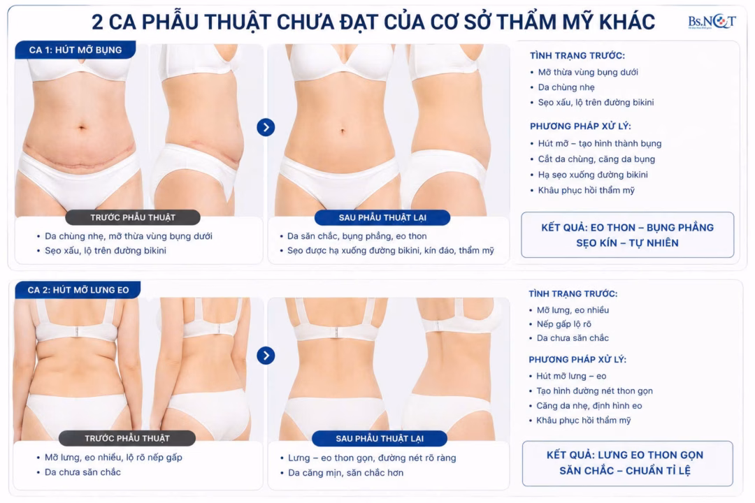 Hình ảnh minh họa tổn thương mô sau khi hút mỡ sai kỹ thuật